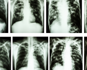 chest x-rays of tuberculosis uc irvine school of nursing postdoc fellow tamara jimah will study treatment adherence in south africa